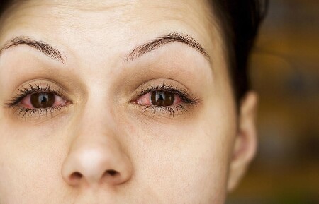 Читать статью "Аллергия глаза – проблема, особенно часто возникающая весной"