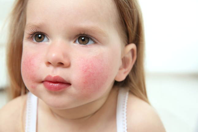 Покраснения на щеках ребенка в возрасте 9 месяцев