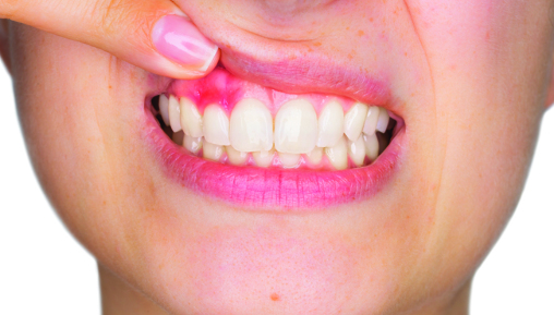 Читать статью "Как сохранить здоровые зубы и десны при диабете"