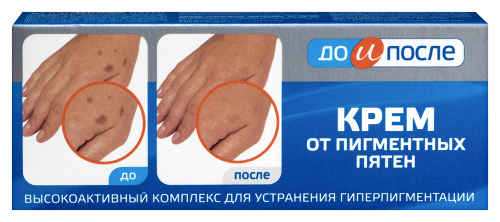До и после крем от пигментных пятен 50 мл