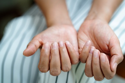 Читать статью "Можно ли распознать диабет по коже и ногтям?"