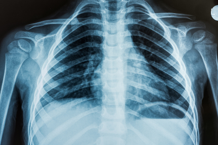 Рентгеновский снимок грудной клетки