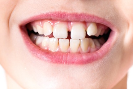 Рот ребенка с кривыми зубами