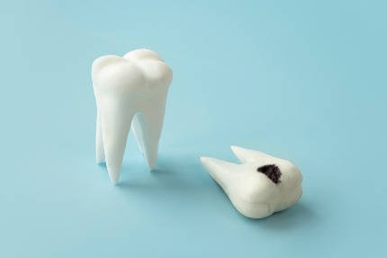 Макет здорового зуба и зуба с кариесом