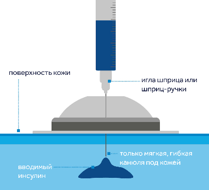 Как колоть инсулин при сахарном диабете | Как правильно делать уколы инсулина