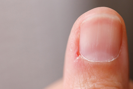 Почему опасно отрывать заусенцы? Читать статью Почему опасно отрывать заусенцы?