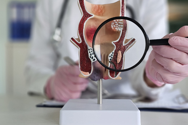 Срок лечения геморроя сократили с года до месяца Читать статью Срок лечения геморроя сократили с года до месяца