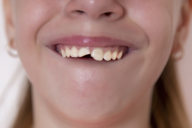 Читать статью Травмы зубов у детей и способы их лечения