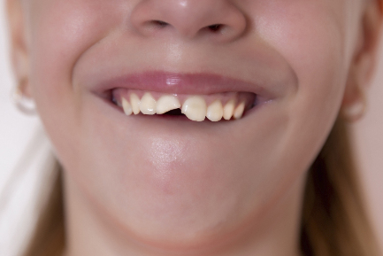 Читать статью "Травмы зубов у детей и способы их лечения"